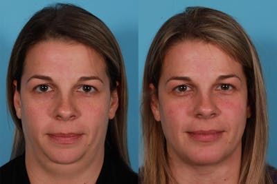 Chin and Cheek Augmentation Before & After Gallery - Patient 402023 - Image 1