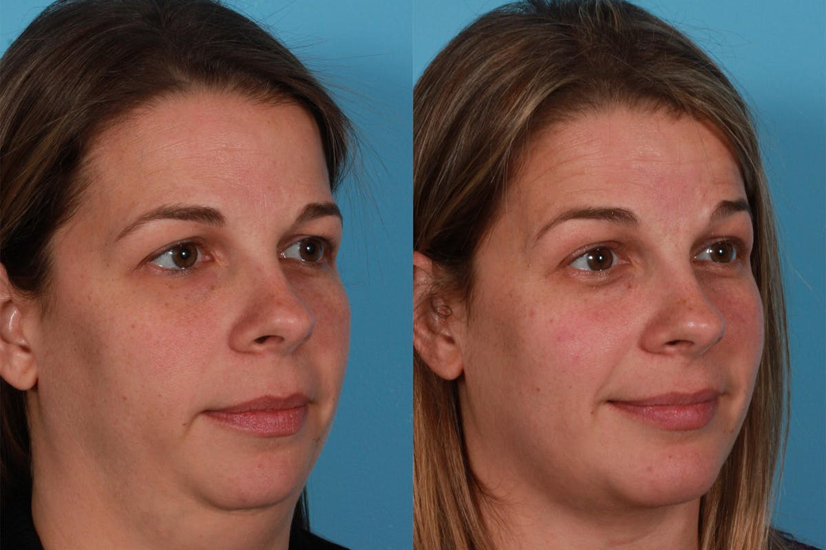 Chin and Cheek Augmentation Before & After Gallery - Patient 402023 - Image 2