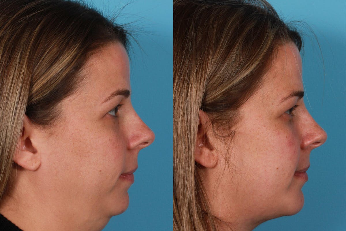 Chin and Cheek Augmentation Before & After Gallery - Patient 402023 - Image 3
