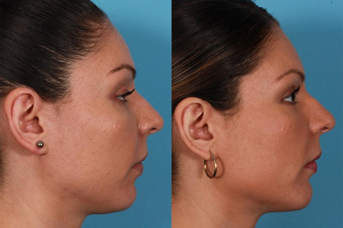 Chin and Cheek Augmentation Before & After Gallery - Patient 215843 - Image 2
