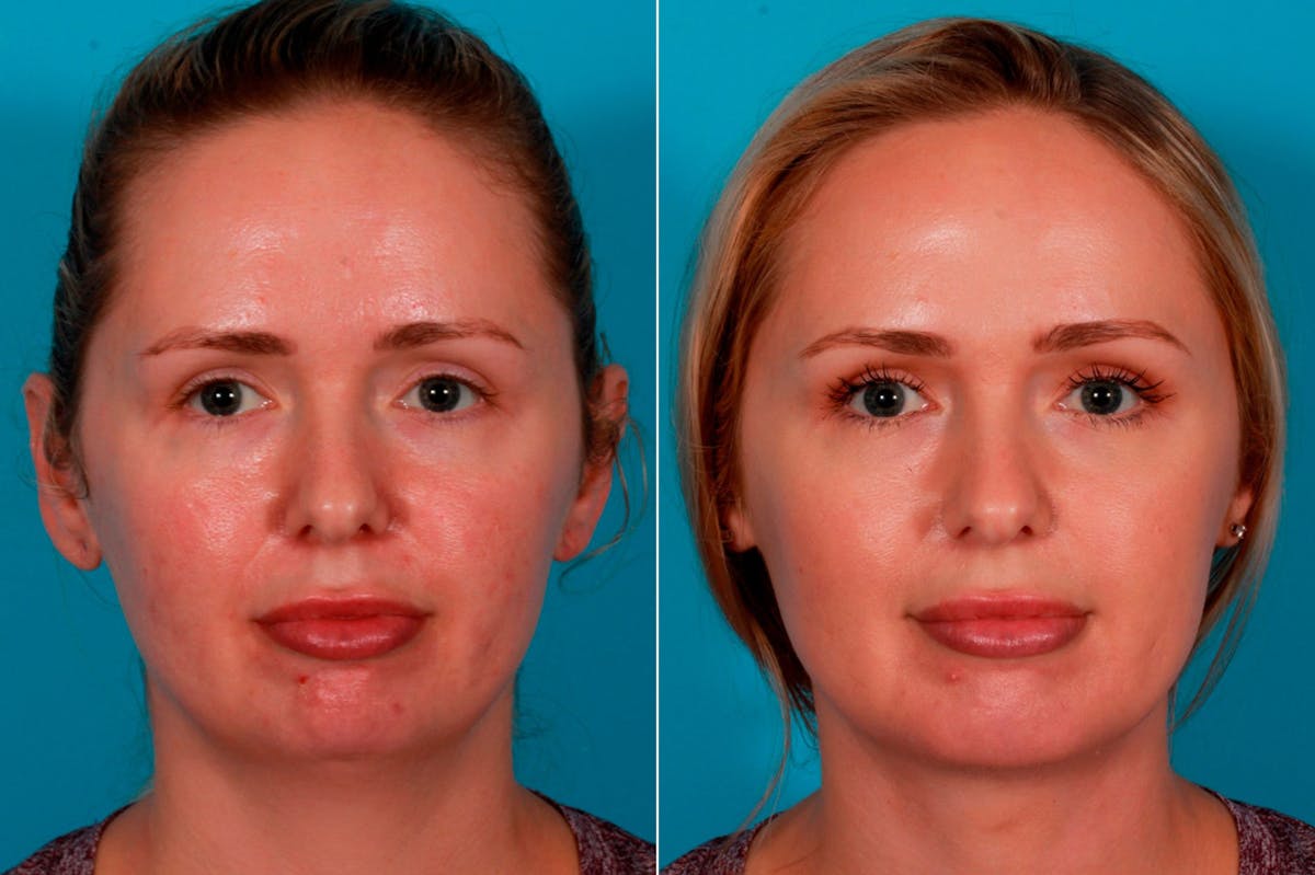 Chin and Cheek Augmentation Before & After Gallery - Patient 349786 - Image 1