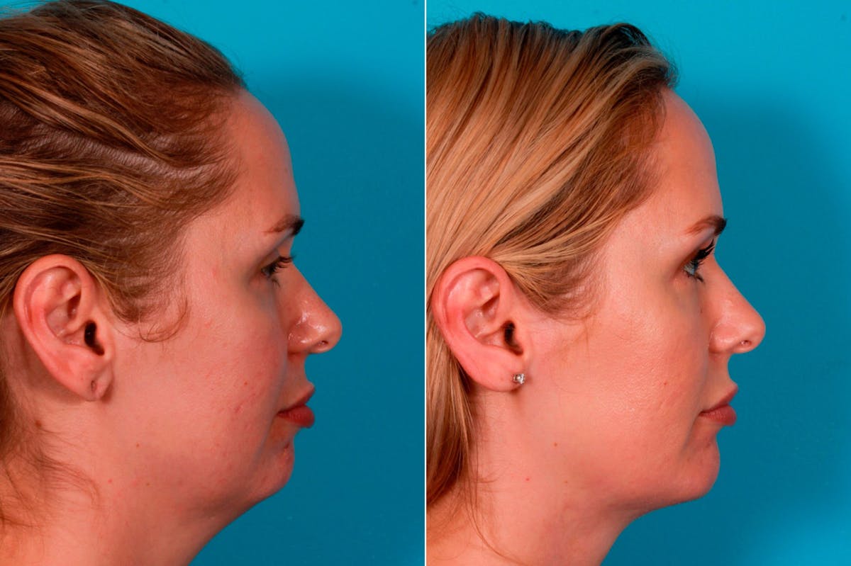 Chin and Cheek Augmentation Before & After Gallery - Patient 349786 - Image 2