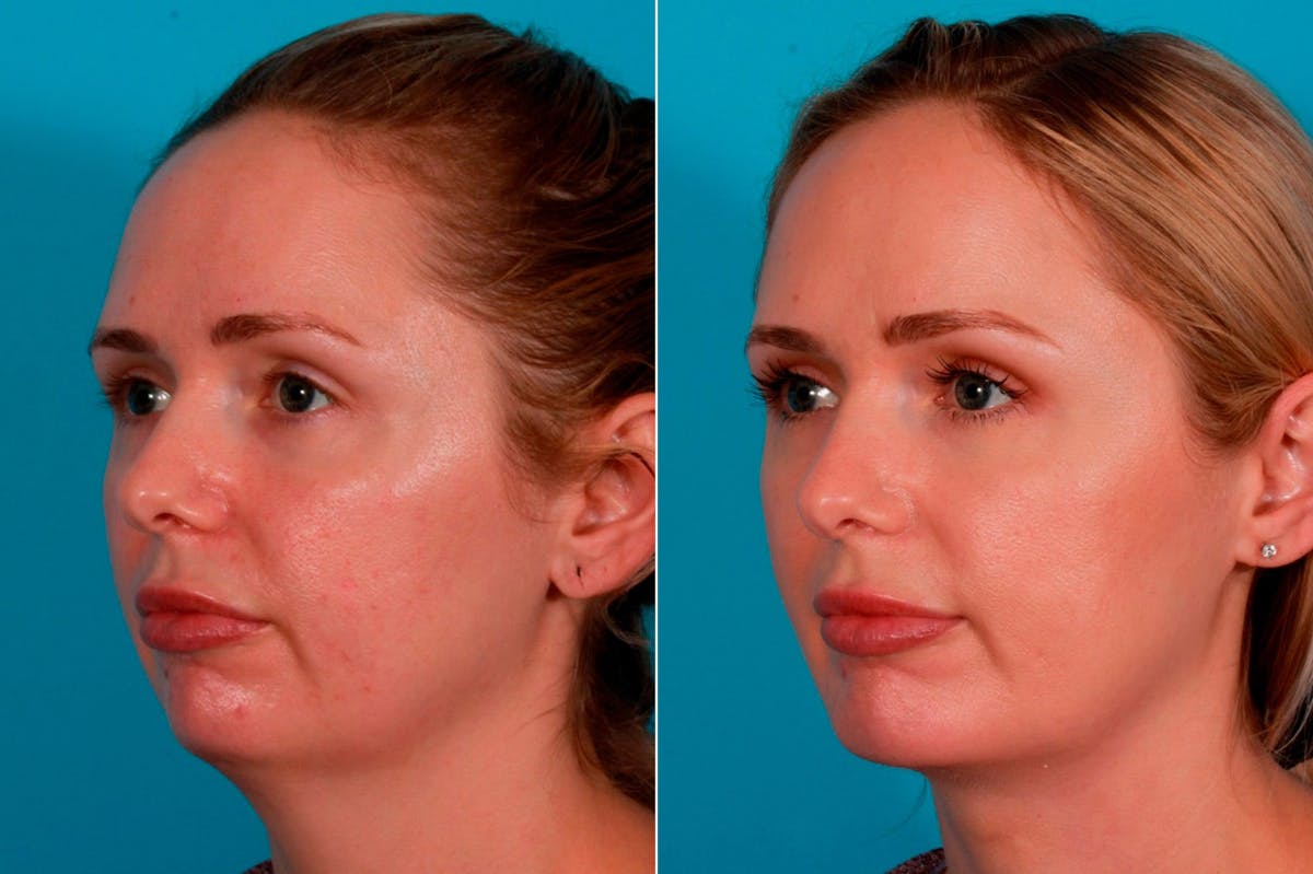 Chin and Cheek Augmentation Before & After Gallery - Patient 349786 - Image 3