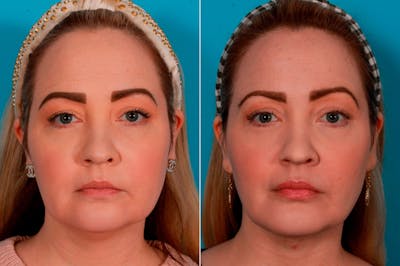 Chin and Cheek Augmentation Before & After Gallery - Patient 136652 - Image 1
