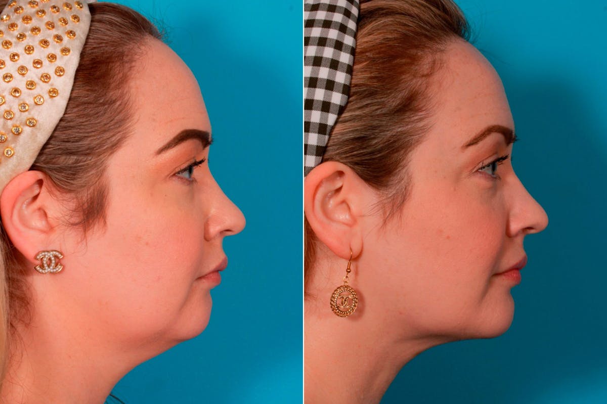 Chin and Cheek Augmentation Before & After Gallery - Patient 136652 - Image 2