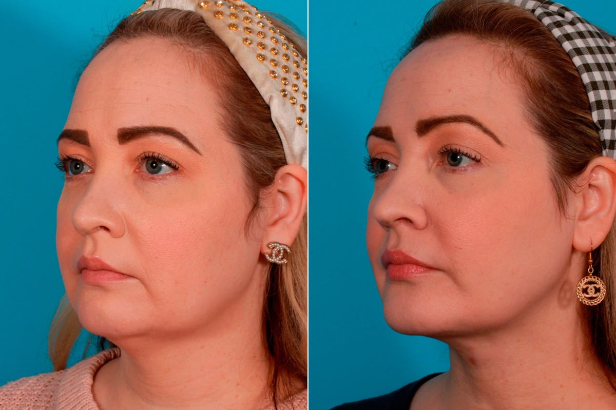 Chin and Cheek Augmentation Before & After Gallery - Patient 136652 - Image 3