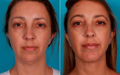Chin and Cheek Augmentation Before & After Gallery - Patient 704319 - Image 1