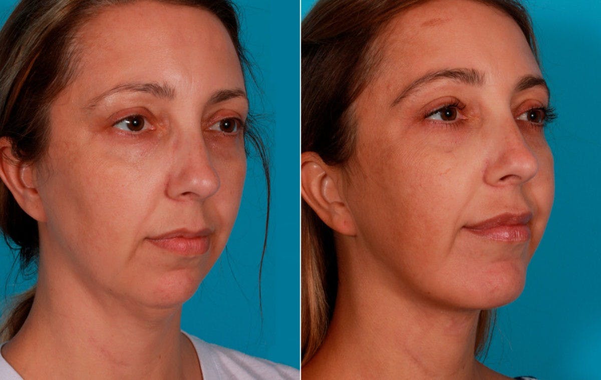 Chin and Cheek Augmentation Before & After Gallery - Patient 704319 - Image 2