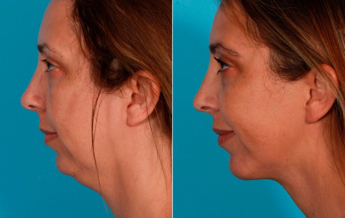 Chin and Cheek Augmentation Before & After Gallery - Patient 704319 - Image 3