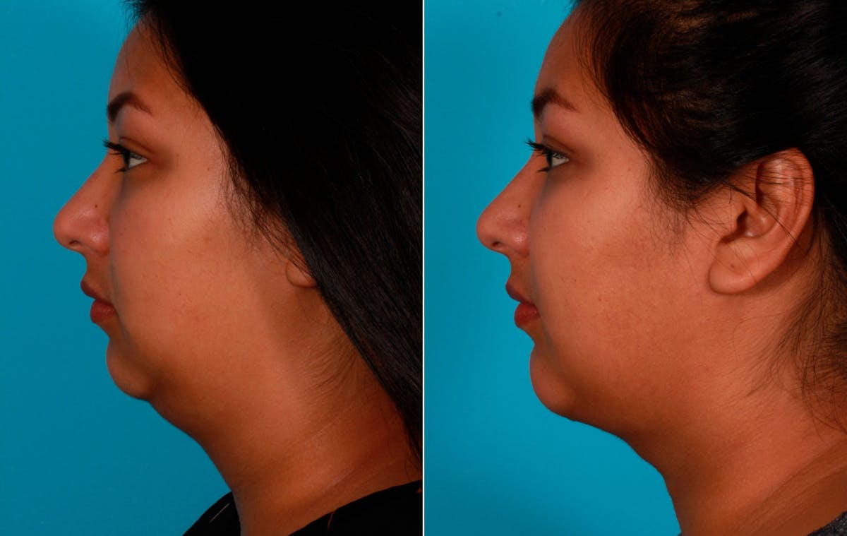 Chin and Cheek Augmentation Before & After Gallery - Patient 323431 - Image 1