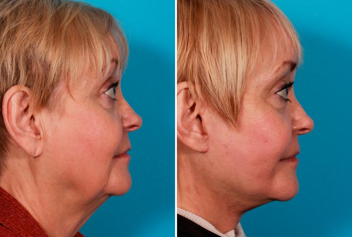 Earlobe Reduction Before & After Gallery - Patient 798779 - Image 2