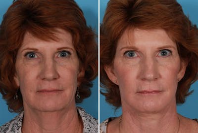 Earlobe Reduction Before & After Gallery - Patient 393154 - Image 1