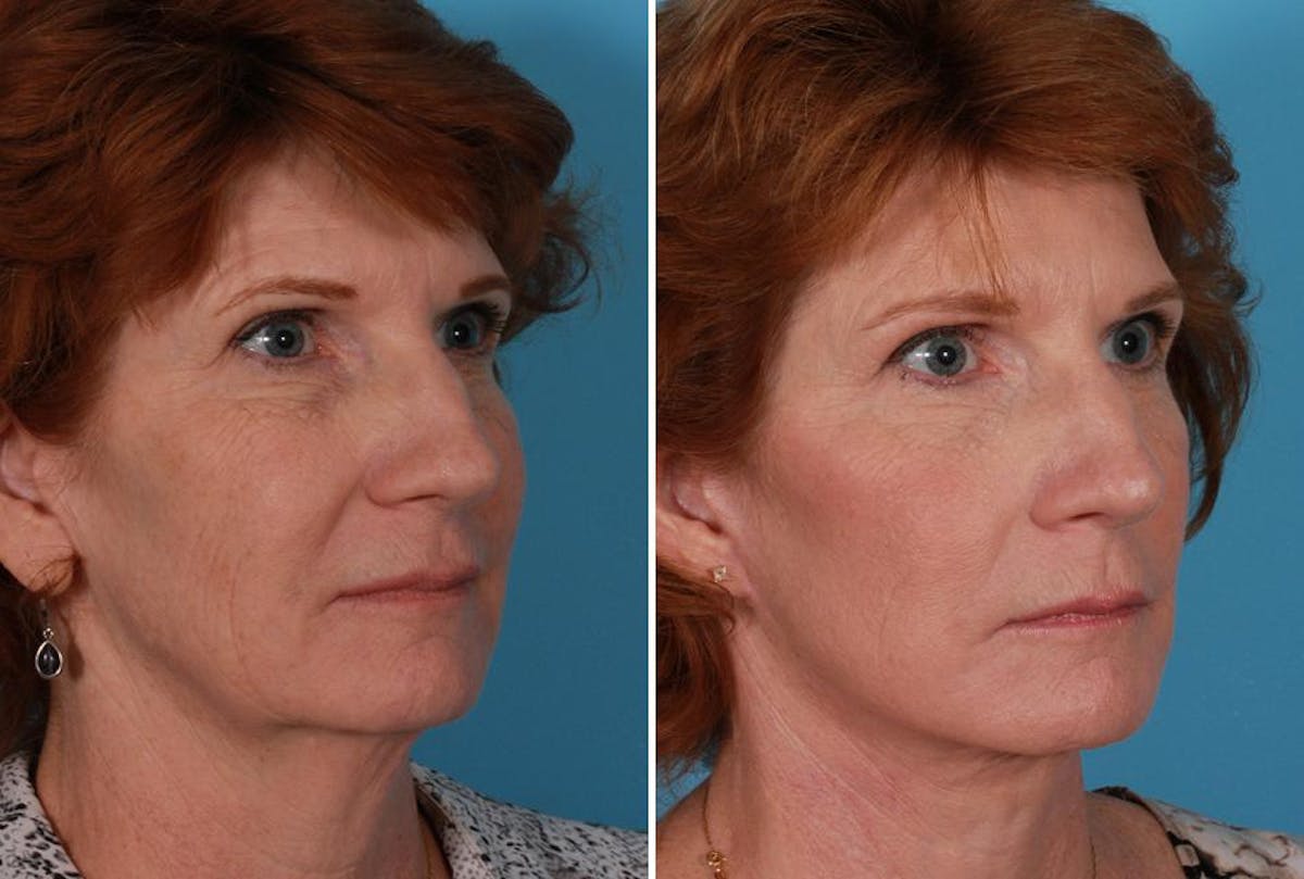 Earlobe Reduction Before & After Gallery - Patient 393154 - Image 2