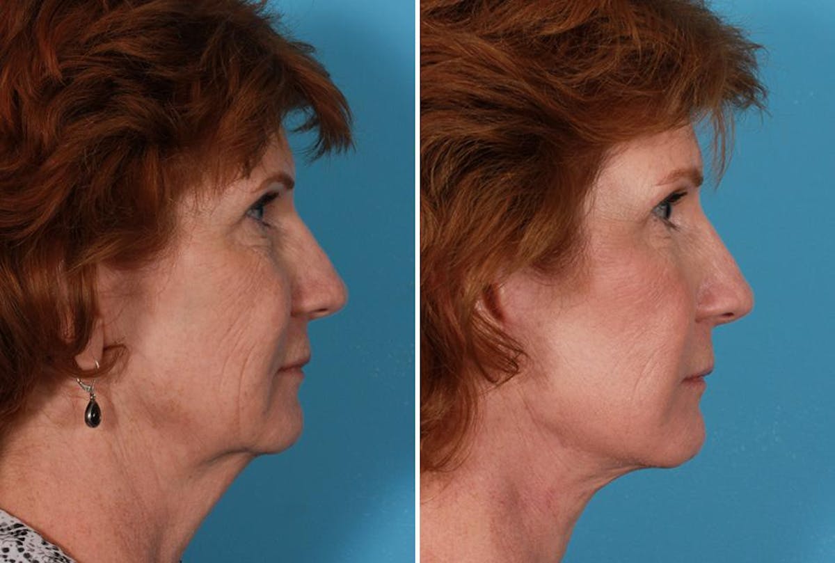 Earlobe Reduction Before & After Gallery - Patient 393154 - Image 3