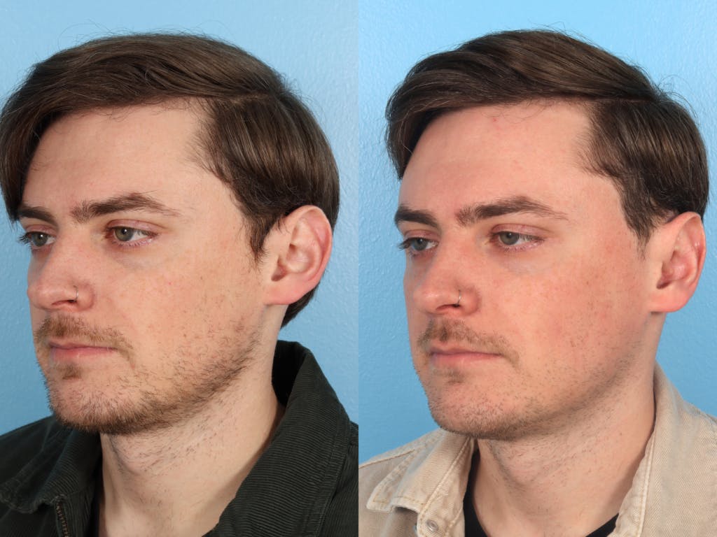 Ear Surgery (Otoplasty) Before & After Gallery - Patient 126372 - Image 2