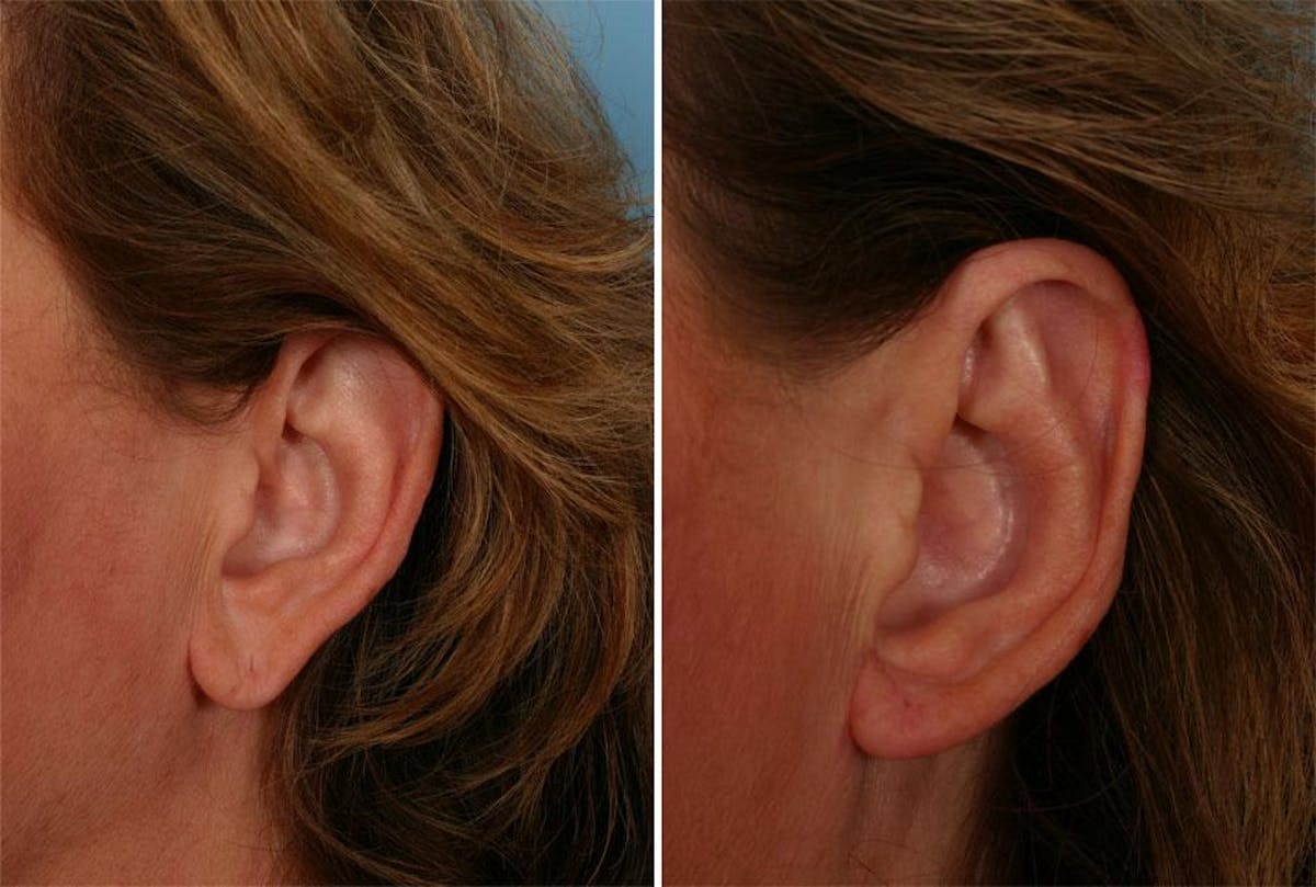 Earlobe Reduction Before & After Gallery - Patient 164228 - Image 2