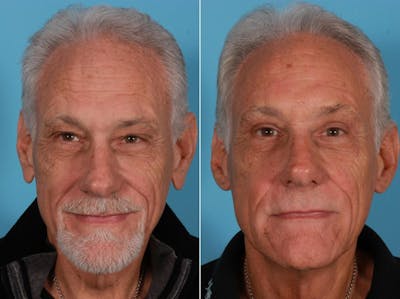 Earlobe Reduction Before & After Gallery - Patient 269246 - Image 1