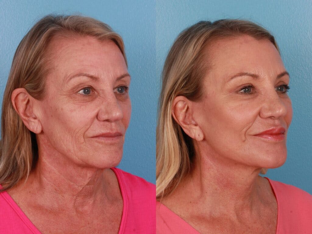 Eyelid Surgery (Blepharoplasty) Before & After Gallery - Patient 317385 - Image 2