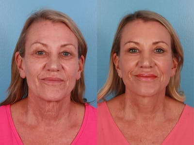 Eyelid Surgery (Blepharoplasty) Before & After Gallery - Patient 317385 - Image 1
