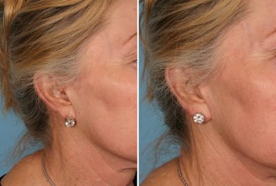 Earlobe Reduction Before & After Gallery - Patient 104005 - Image 1