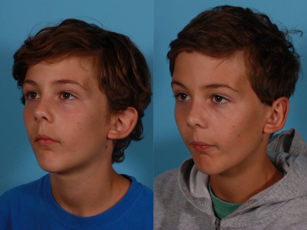 Ear Surgery (Otoplasty) Before & After Gallery - Patient 500391 - Image 2