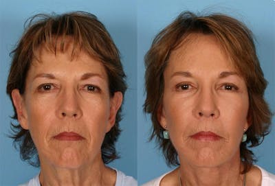 Endoscoplic Browlift Before & After Gallery - Patient 136257 - Image 1