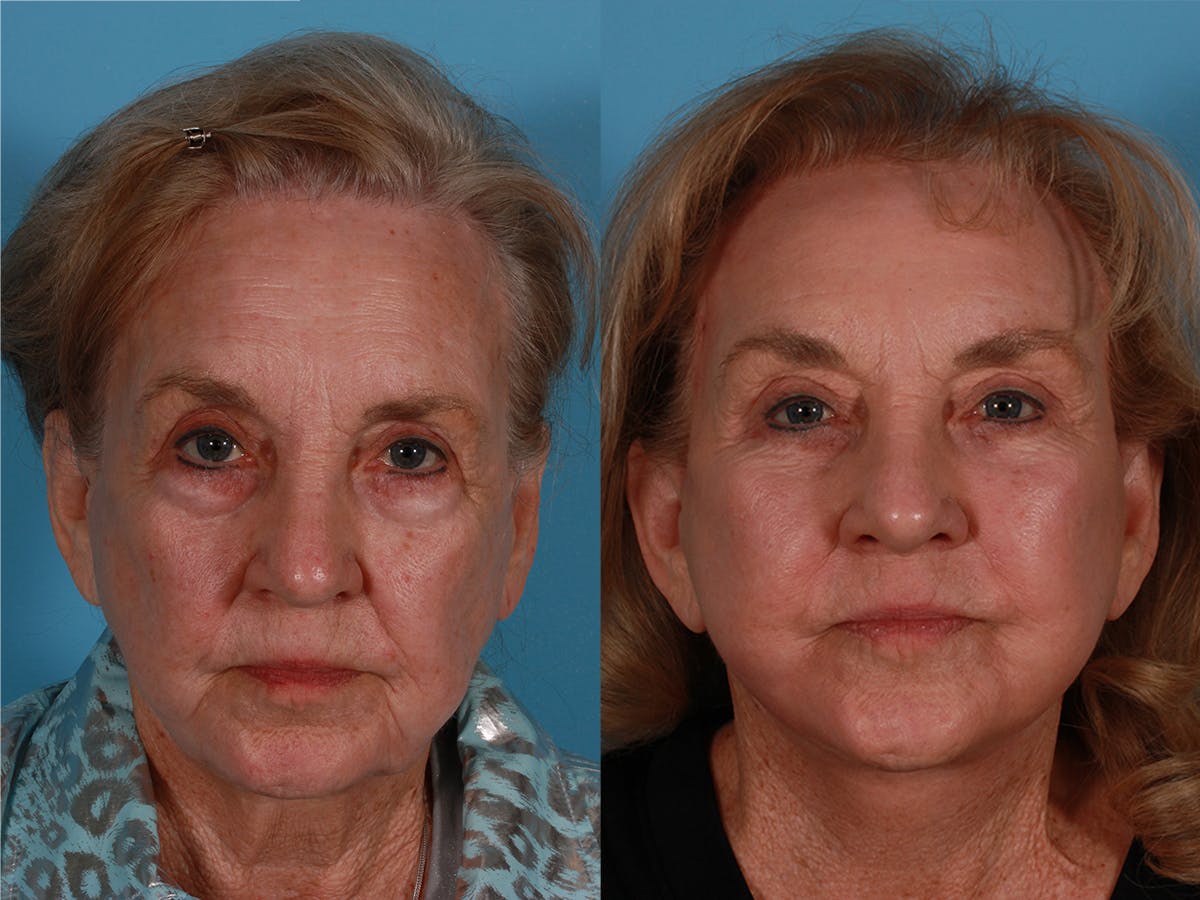 Eyelid Surgery (Blepharoplasty) Before & After Gallery - Patient 388792 - Image 1