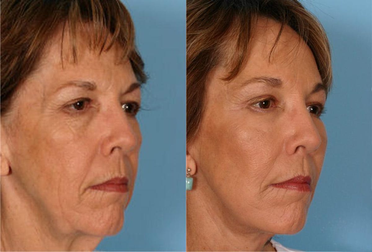 Endoscoplic Browlift Before & After Gallery - Patient 136257 - Image 2