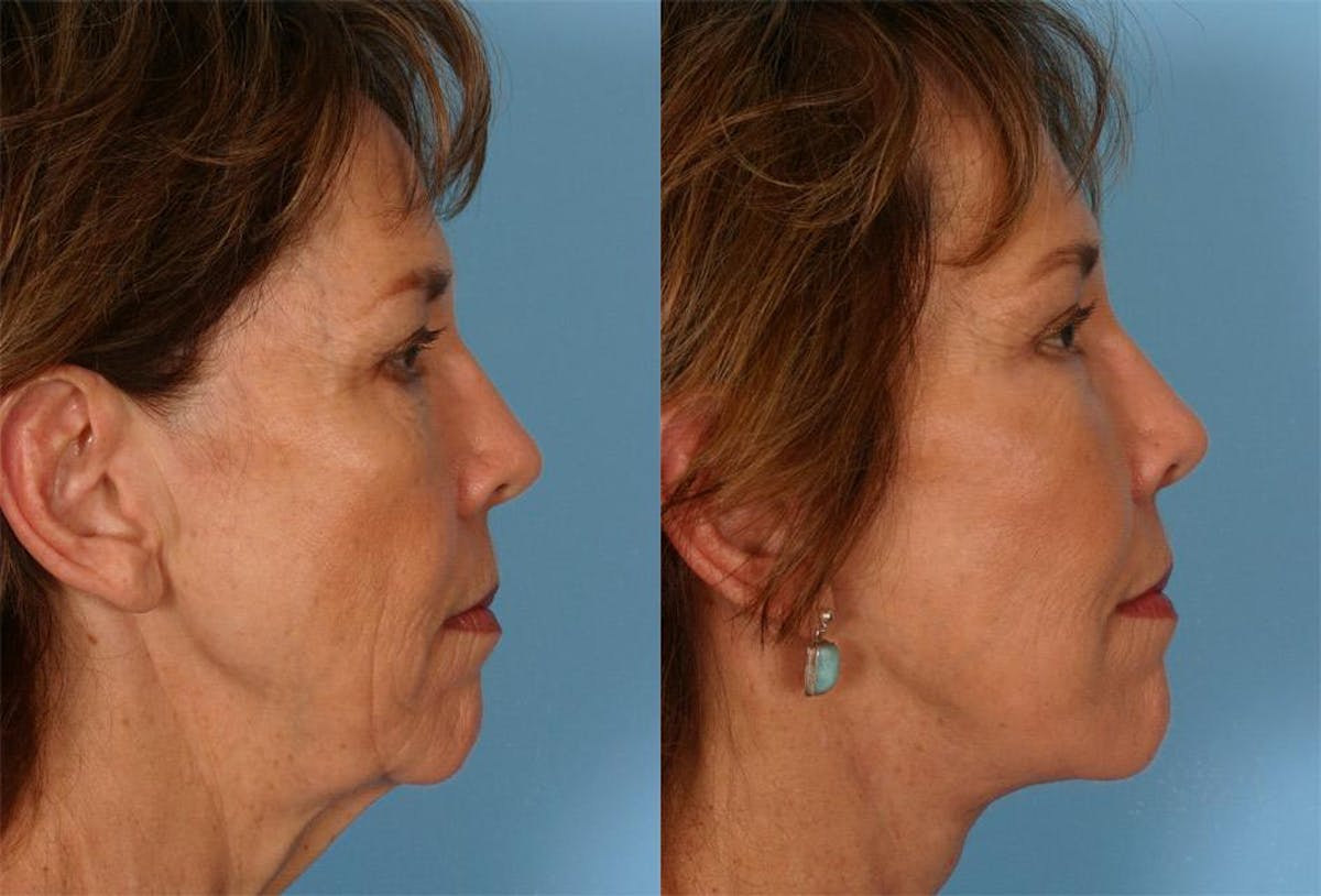 Endoscoplic Browlift Before & After Gallery - Patient 136257 - Image 3
