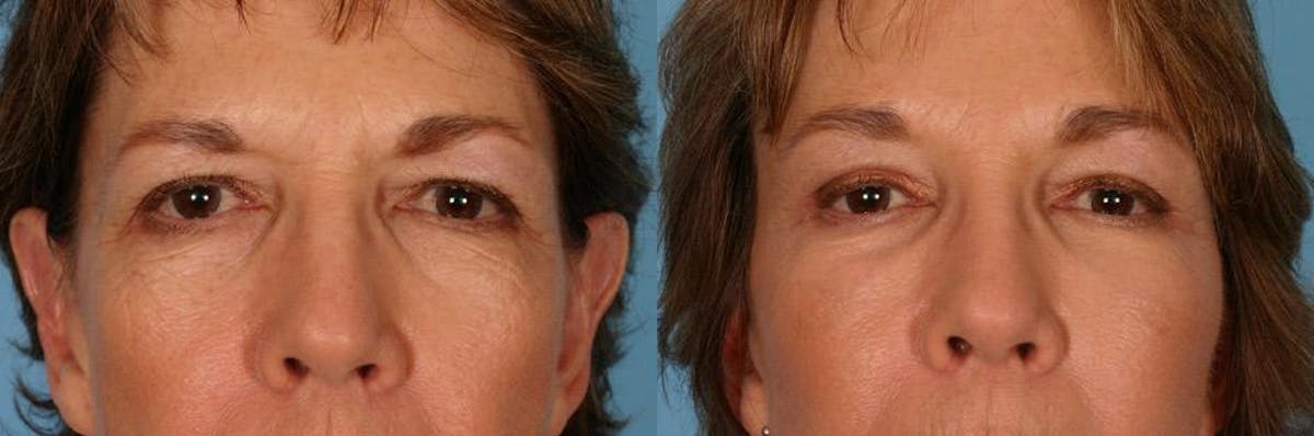 Endoscoplic Browlift Before & After Gallery - Patient 136257 - Image 4