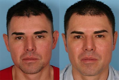 Ear Surgery (Otoplasty) Before & After Gallery - Patient 150626 - Image 1