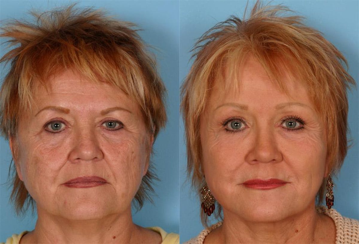 Endoscoplic Browlift Before & After Gallery - Patient 118456 - Image 1