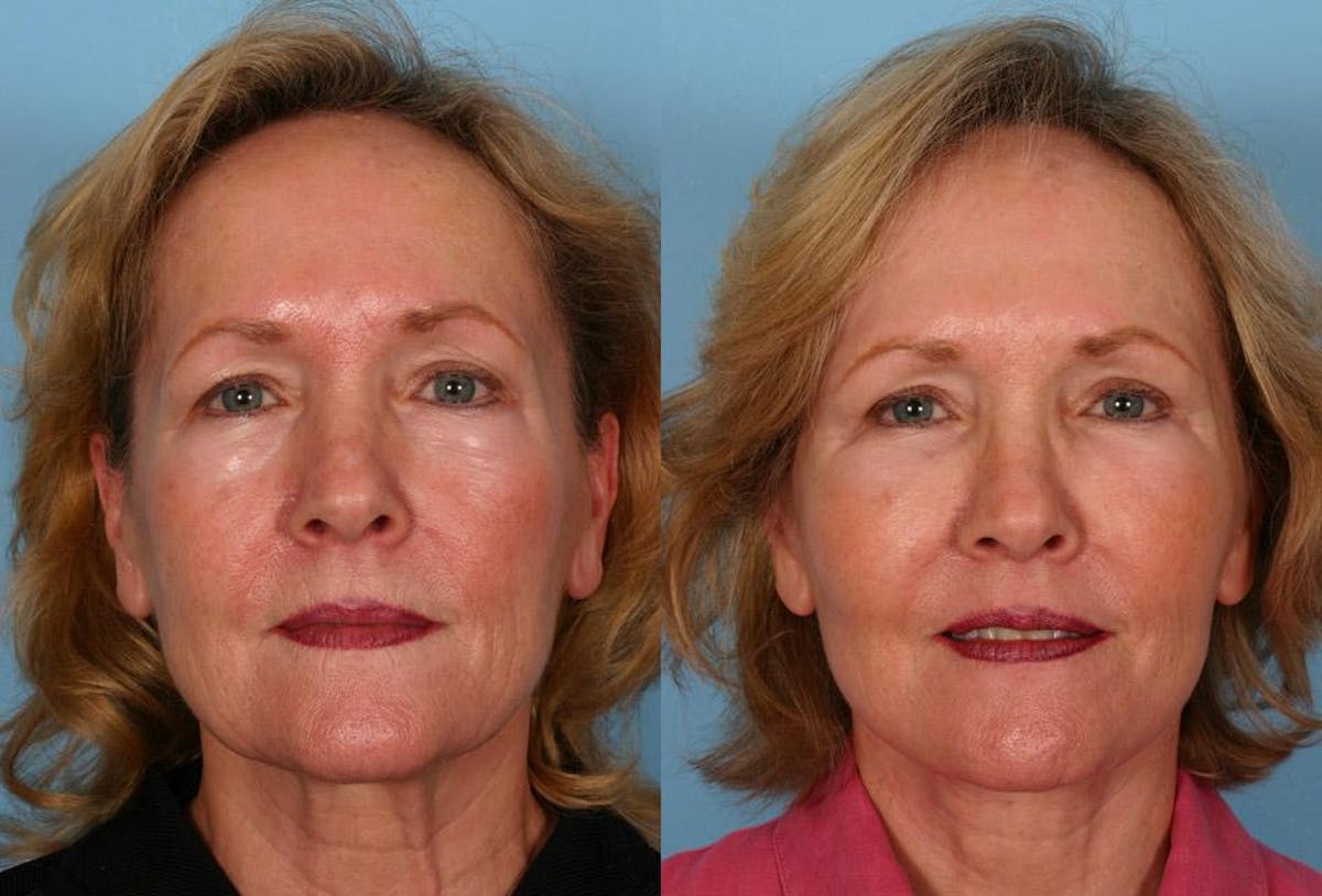 Facelift Before & After Gallery - Patient 377581 - Image 1