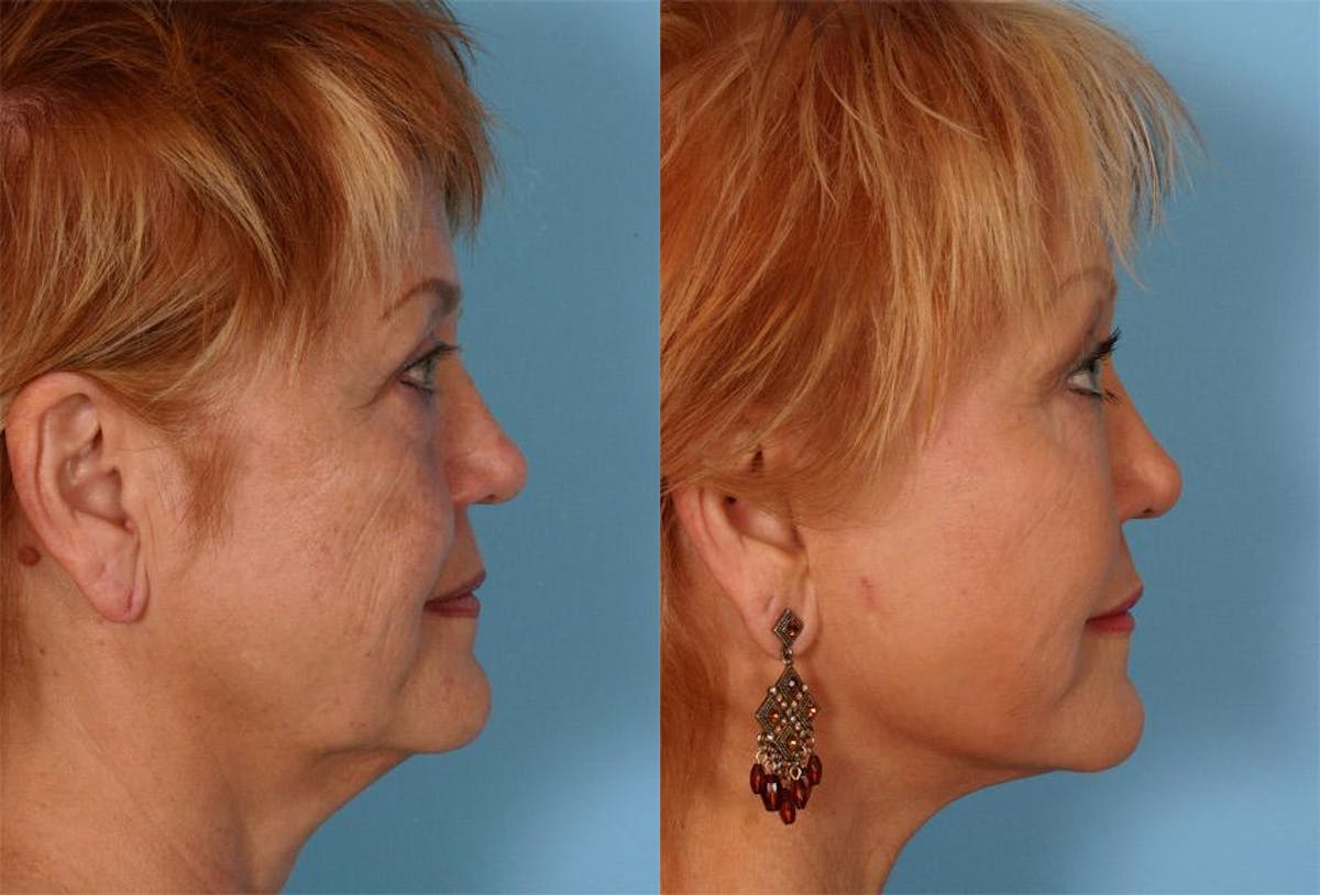 Endoscoplic Browlift Before & After Gallery - Patient 118456 - Image 3