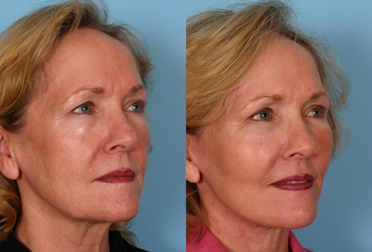 Facelift Before & After Gallery - Patient 377581 - Image 2