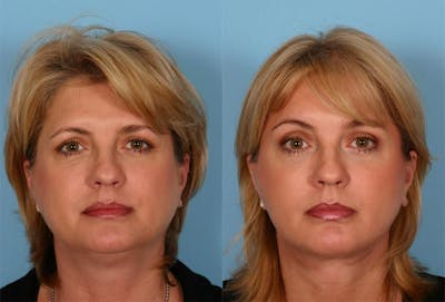 Eyelid Surgery (Blepharoplasty) Before & After Gallery - Patient 294301 - Image 1