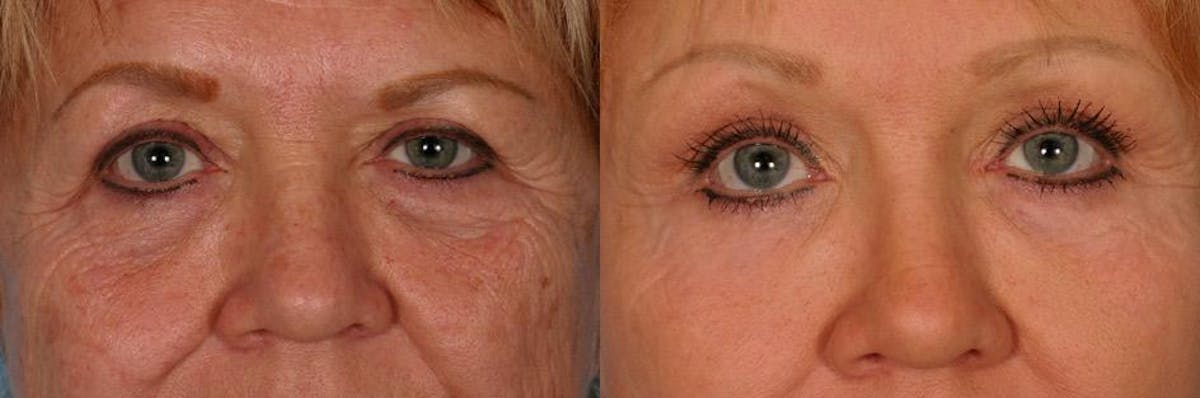 Endoscoplic Browlift Before & After Gallery - Patient 118456 - Image 4