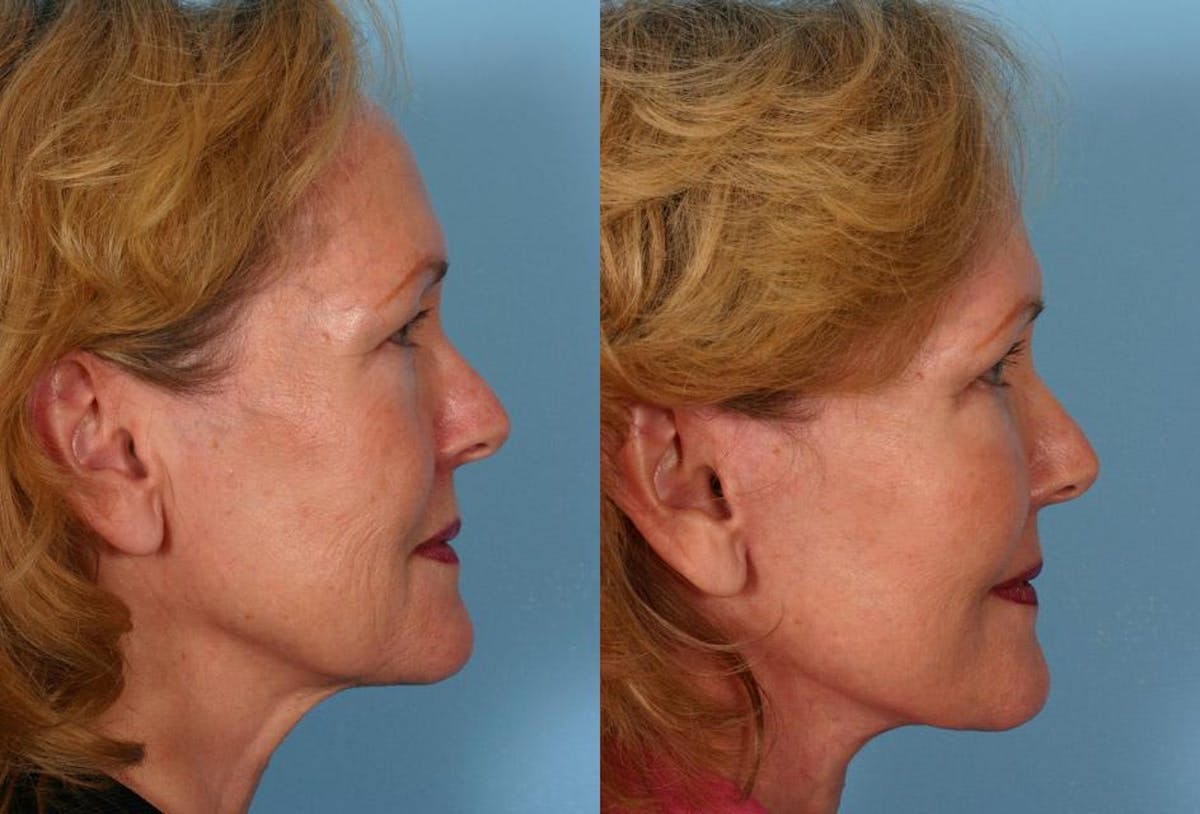 Facelift Before & After Gallery - Patient 377581 - Image 3