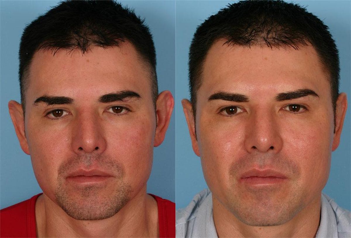 Ear Surgery (Otoplasty) Before & After Gallery - Patient 150626 - Image 5