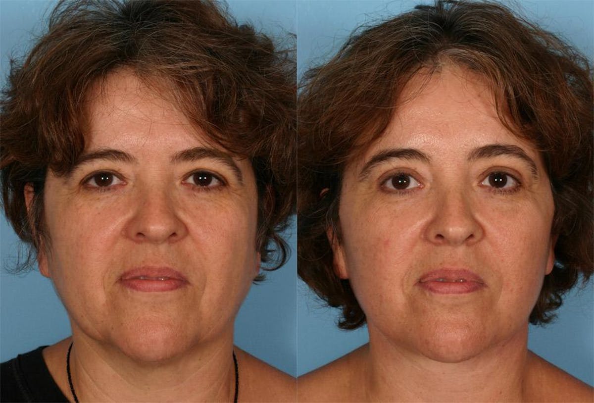 Endoscoplic Browlift Before & After Gallery - Patient 102366 - Image 1