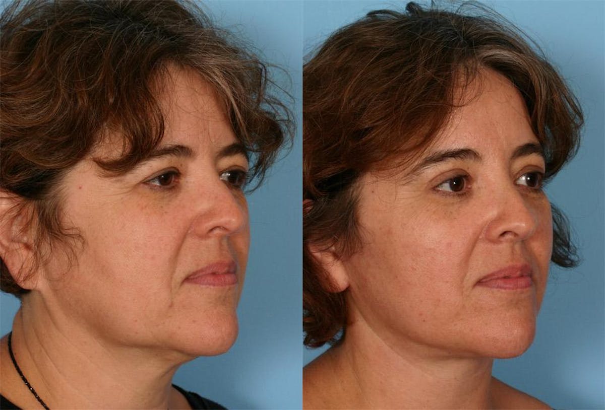 Endoscoplic Browlift Before & After Gallery - Patient 102366 - Image 2