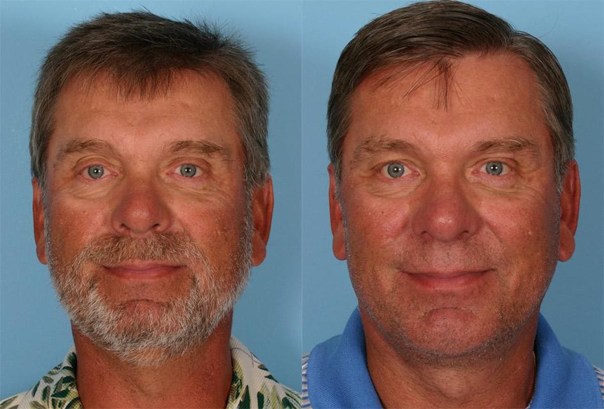Facelift Before & After Gallery - Patient 559524 - Image 1