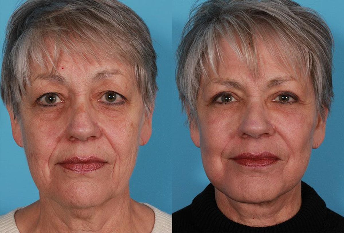 Facial Fat Transfer Before & After Gallery - Patient 405515 - Image 1