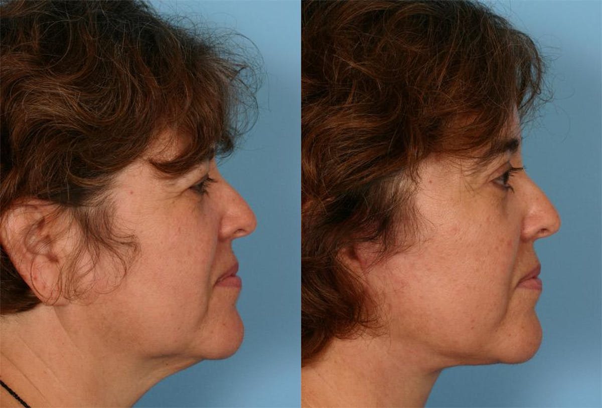 Endoscoplic Browlift Before & After Gallery - Patient 102366 - Image 3