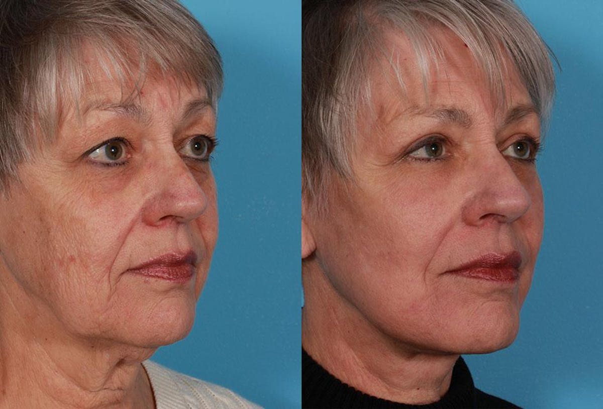 Facial Fat Transfer Before & After Gallery - Patient 405515 - Image 2