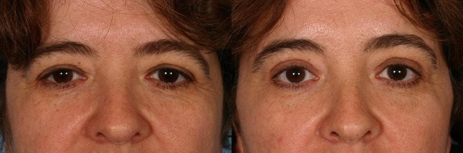 Endoscopic Brow Lift Before & After Gallery - Patient 102366 - Image 4