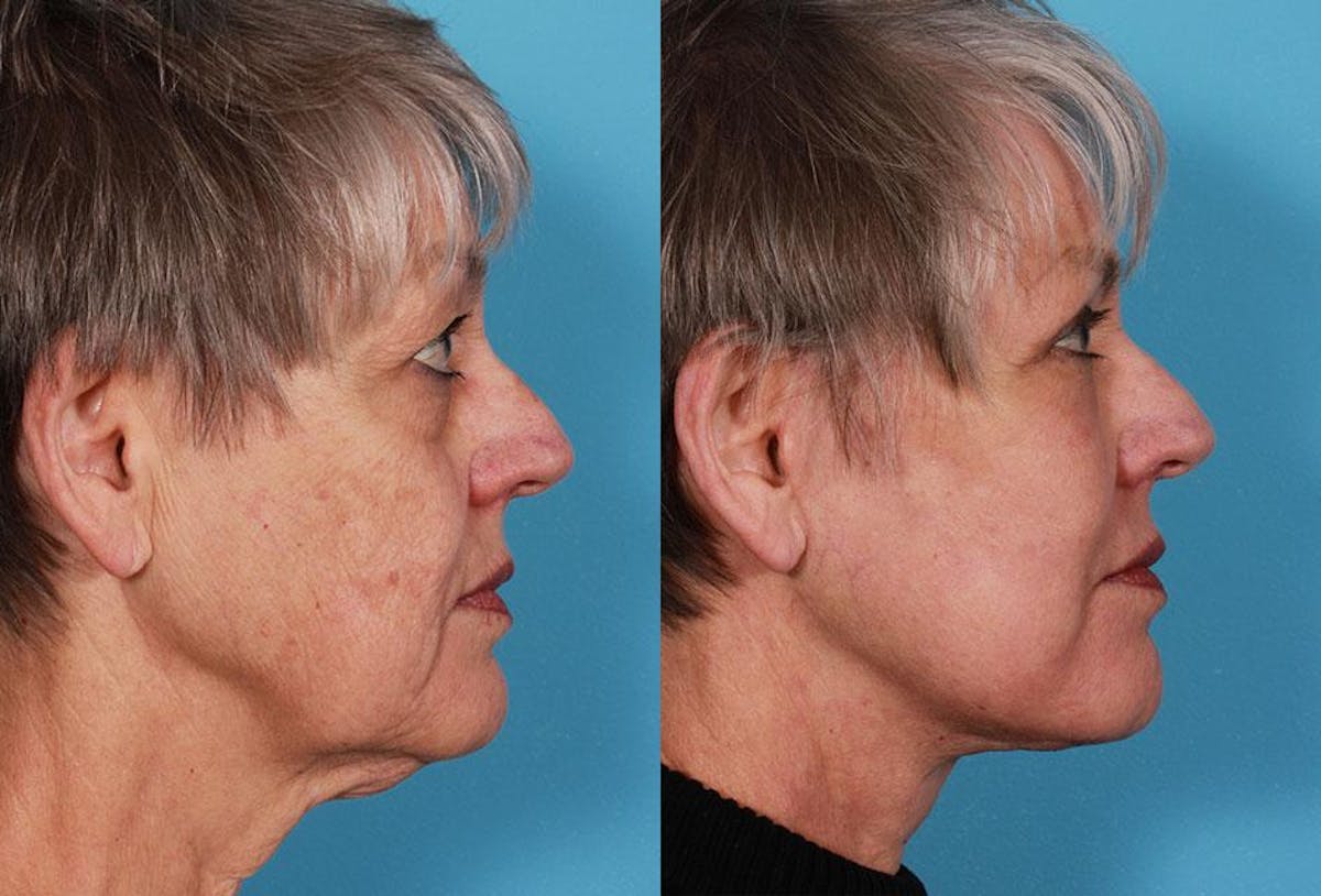 Facial Fat Transfer Before & After Gallery - Patient 405515 - Image 3