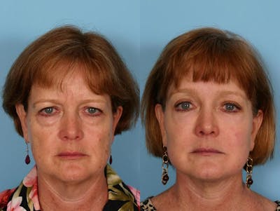 Endoscoplic Browlift Before & After Gallery - Patient 348502 - Image 1