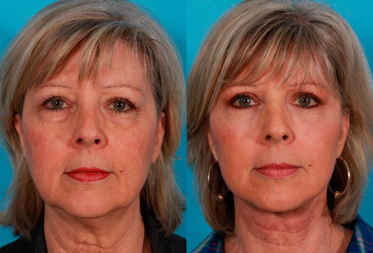 Facial Fat Transfer Before & After Gallery - Patient 786981 - Image 1