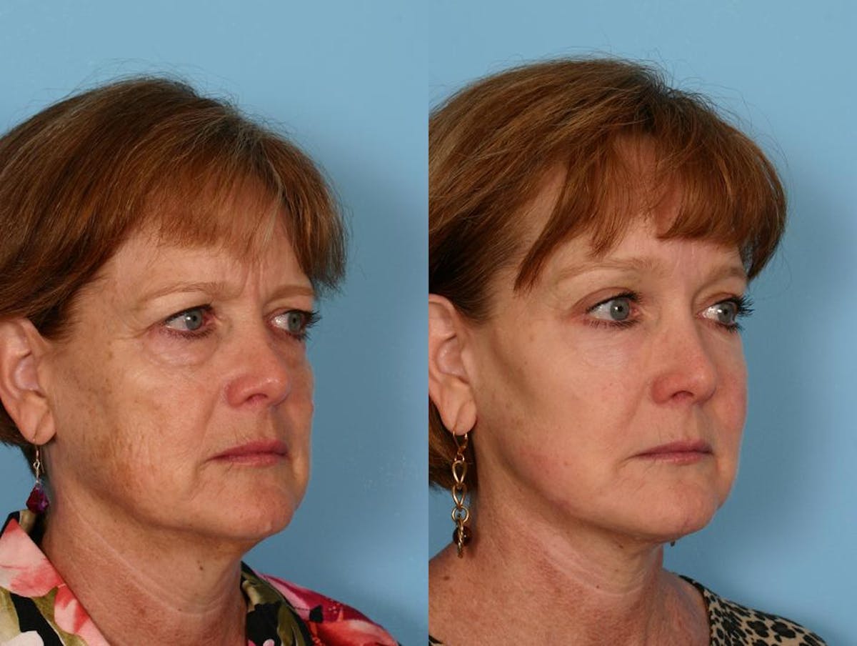 Endoscoplic Browlift Before & After Gallery - Patient 348502 - Image 2